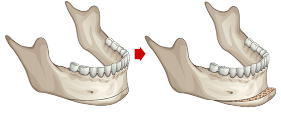 下颌骨手术图332.gif